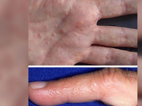 Granitos manos: la grave enfermedad que puede agarrar - Pasa Salta